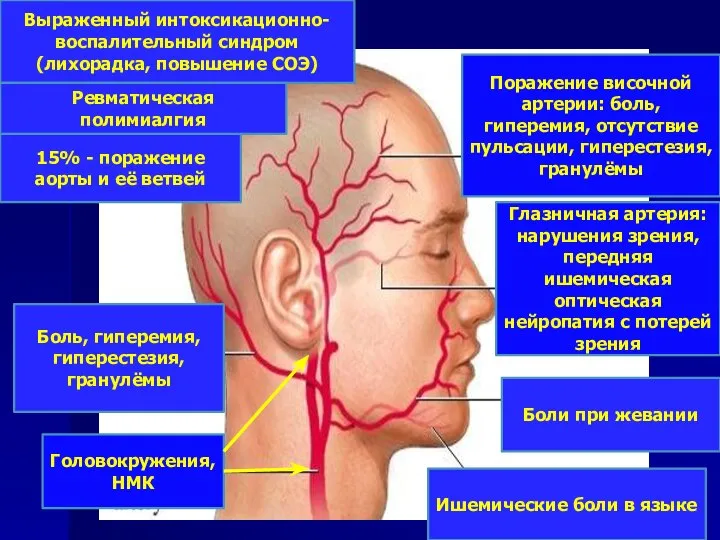 Поражение височной артерии: боль, гиперемия, отсутствие пульсации, гиперестезия, гранулёмы Глазничная артерия: нарушения