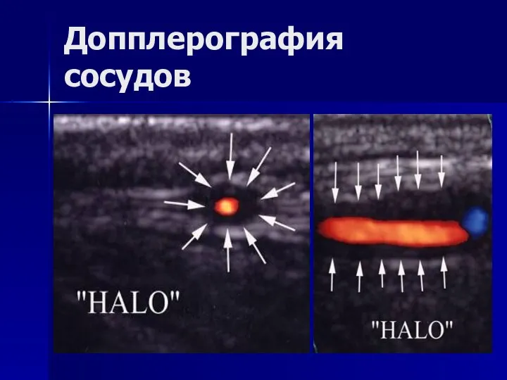 Допплерография сосудов