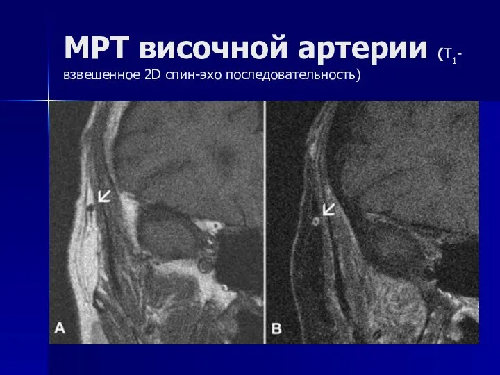 МРТ височной артерии (T1-взвешенное 2D спин-эхо последовательность)