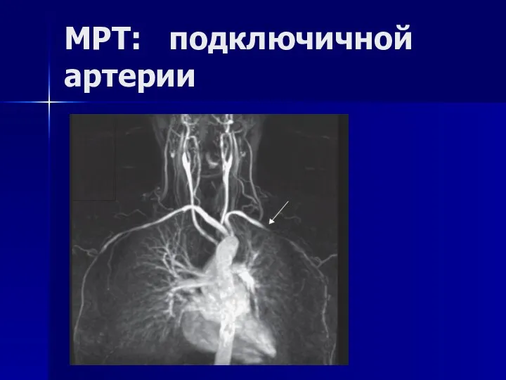МРТ: подключичной артерии