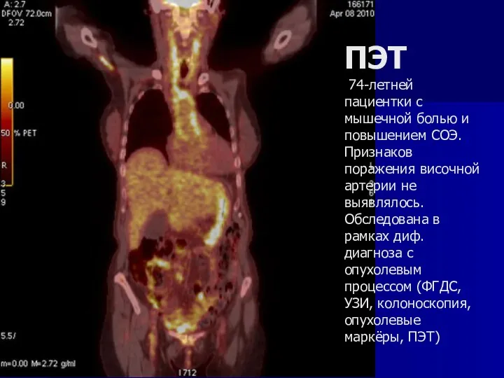 ПЭТ 74-летней пациентки с мышечной болью и повышением СОЭ. Признаков поражения височной