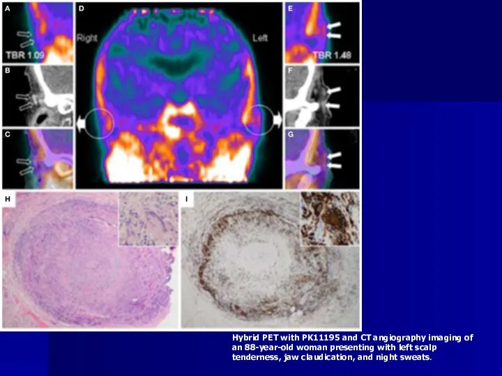 Hybrid PET with PK11195 and CT angiography imaging of an 88-year-old woman