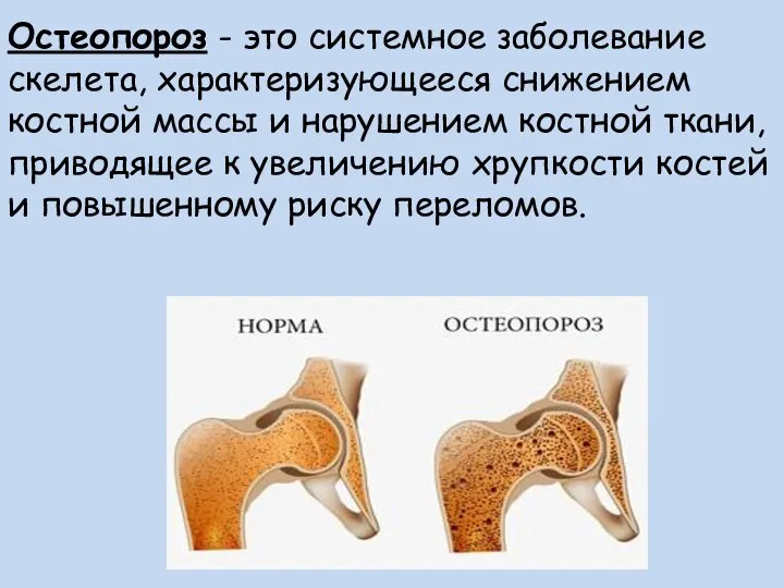 Остеопороз - это системное заболевание скелета, характеризующееся снижением костной массы и нарушением