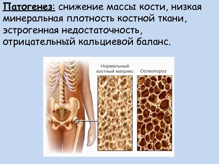 Патогенез: снижение массы кости, низкая минеральная плотность костной ткани, эстрогенная недостаточность, отрицательный кальциевой баланс.