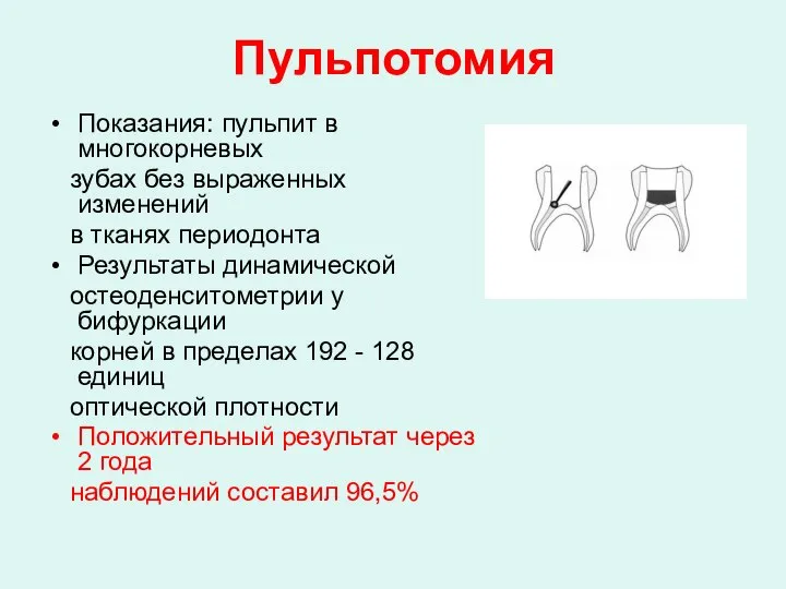 Пульпотомия Показания: пульпит в многокорневых зубах без выраженных изменений в тканях периодонта