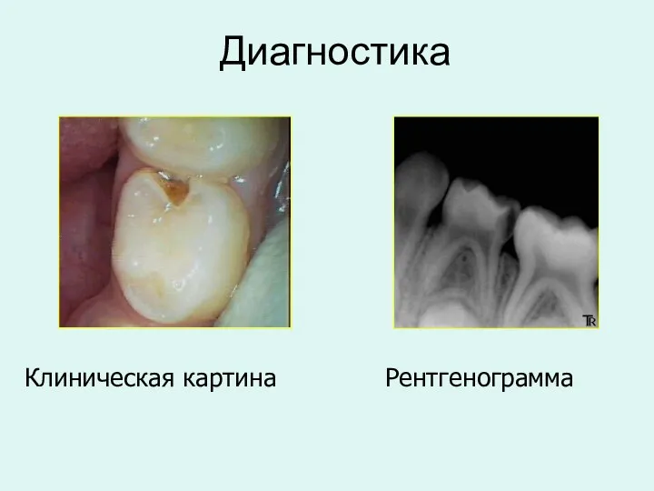 Диагностика Клиническая картина Рентгенограмма