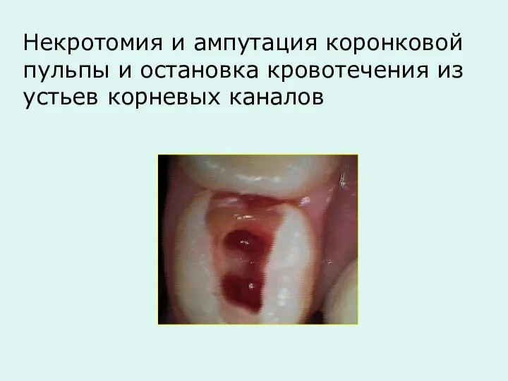 Некротомия и ампутация коронковой пульпы и остановка кровотечения из устьев корневых каналов