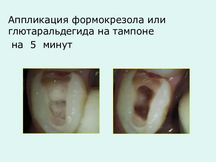 Аппликация формокрезола или глютаральдегида на тампоне на 5 минут