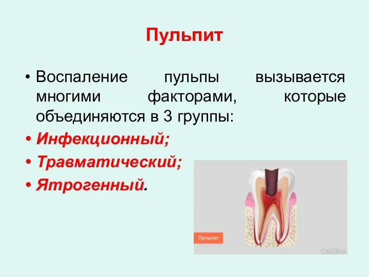 Пульпит Воспаление пульпы вызывается многими факторами, которые объединяются в 3 группы: Инфекционный; Травматический; Ятрогенный.