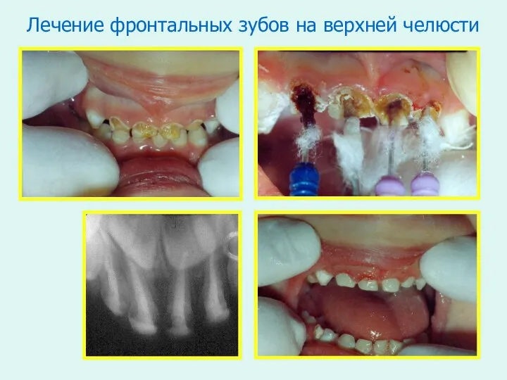 Лечение фронтальных зубов на верхней челюсти