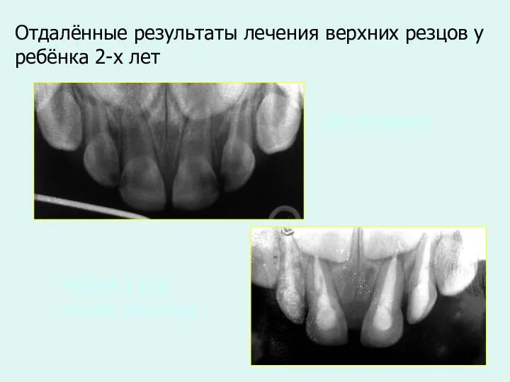 Отдалённые результаты лечения верхних резцов у ребёнка 2-х лет До лечения Через 1 год после лечения