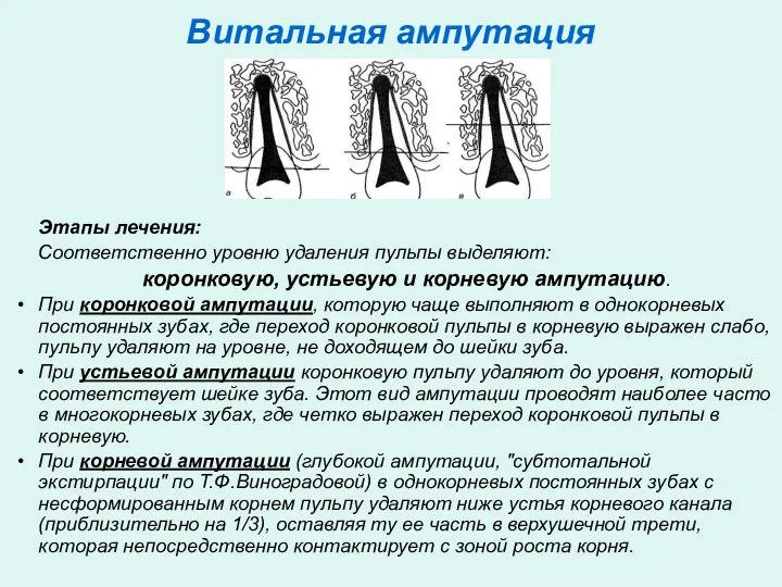 Витальная ампутация Этапы лечения: Соответственно уровню удаления пульпы выделяют: коронковую, устьевую и