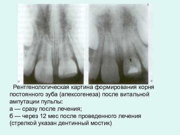 Рентгенологическая картина формирования корня постоянного зуба (апексогенеза) после витальной ампутации пульпы: а
