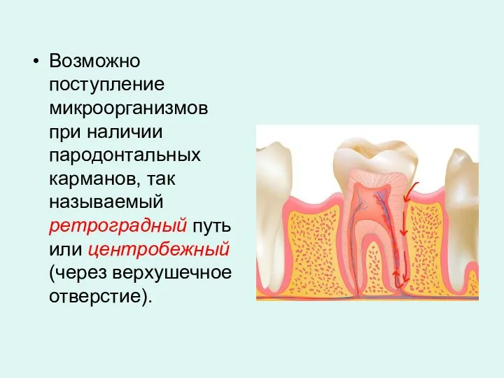 Возможно поступление микроорганизмов при наличии пародонтальных карманов, так называемый ретроградный путь или центробежный (через верхушечное отверстие).