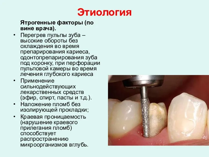 Этиология Ятрогенные факторы (по вине врача). Перегрев пульпы зуба – высокие обороты