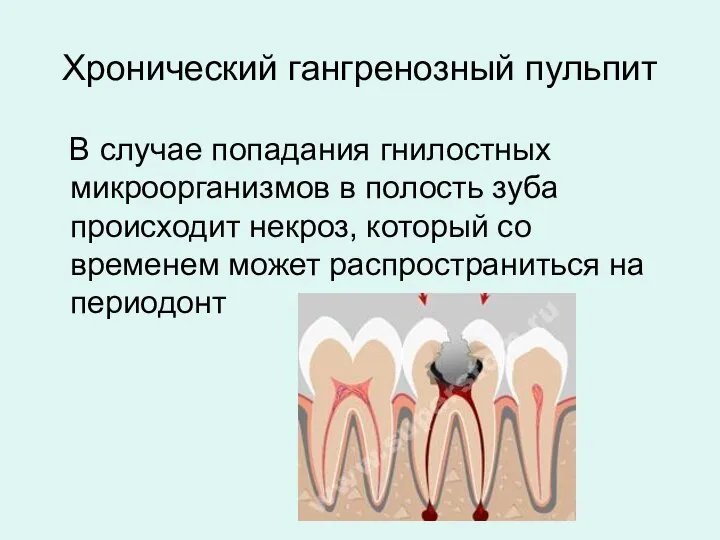 Хронический гангренозный пульпит В случае попадания гнилостных микроорганизмов в полость зуба происходит