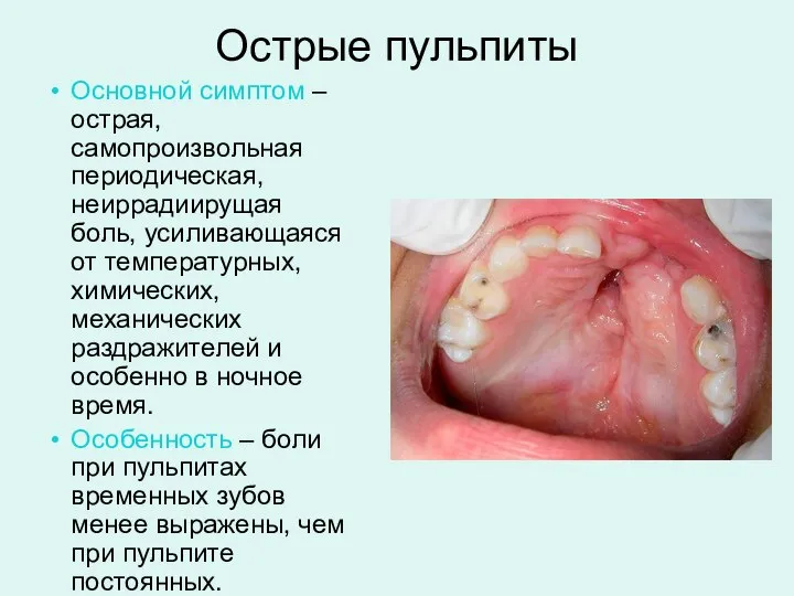 Острые пульпиты Основной симптом – острая, самопроизвольная периодическая, неиррадиирущая боль, усиливающаяся от