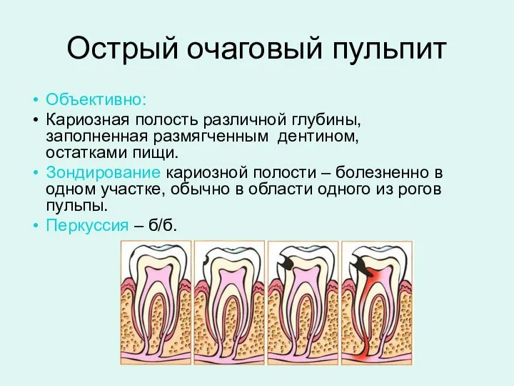 Острый очаговый пульпит Объективно: Кариозная полость различной глубины, заполненная размягченным дентином, остатками