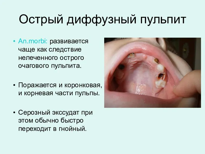 Острый диффузный пульпит An.morbi: развивается чаще как следствие нелеченного острого очагового пульпита.