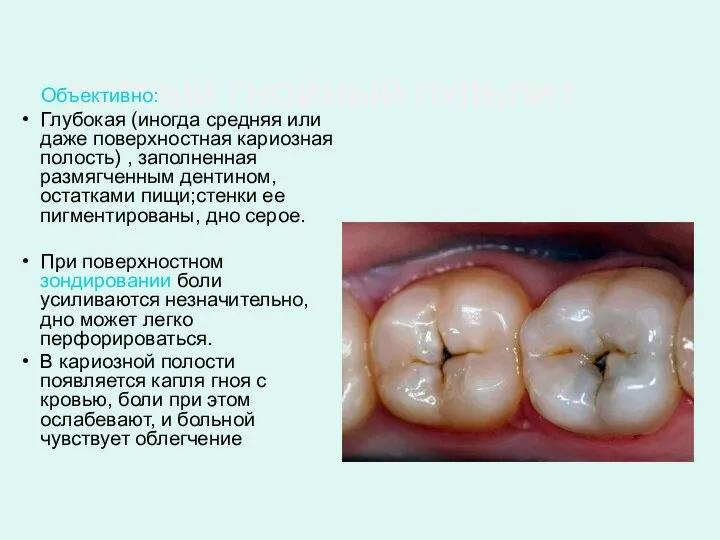 ОСТРЫЙ ГНОЙНЫЙ ПУЛЬПИТ Объективно: Глубокая (иногда средняя или даже поверхностная кариозная полость)