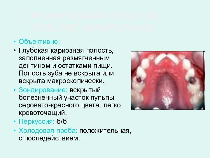 ХРОНИЧЕСКИЙ ПРОСТОЙ ПУЛЬПИТ (ФИБРОЗНЫЙ) Объективно: Глубокая кариозная полость, заполненная размягченным дентином и