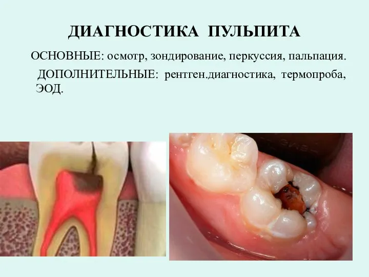 ДИАГНОСТИКА ПУЛЬПИТА ОСНОВНЫЕ: осмотр, зондирование, перкуссия, пальпация. ДОПОЛНИТЕЛЬНЫЕ: рентген.диагностика, термопроба, ЭОД.