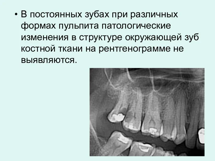 В постоянных зубах при различных формах пульпита патологические изменения в структуре окружающей