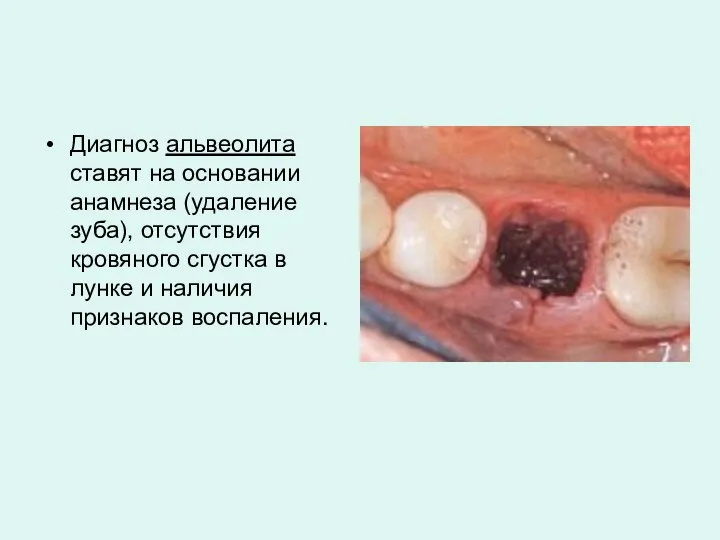 Диагноз альвеолита ставят на основании анамнеза (удаление зуба), отсутствия кровяного сгустка в