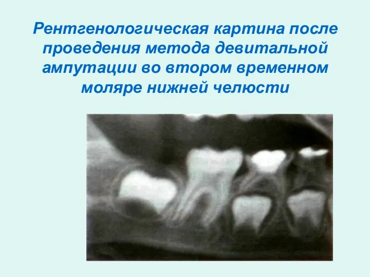 Рентгенологическая картина после проведения метода девитальной ампутации во втором временном моляре нижней челюсти