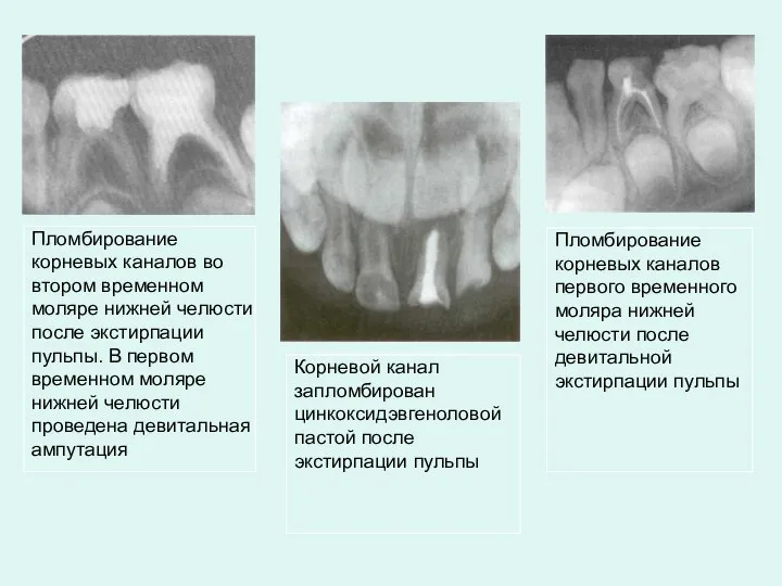 Пломбирование корневых каналов во втором временном моляре нижней челюсти после экстирпации пульпы.