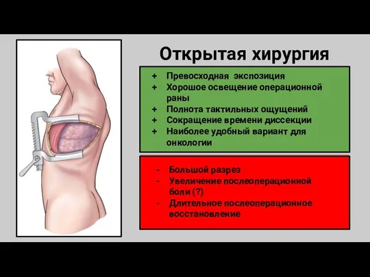 Открытая хирургия Превосходная экспозиция Хорошое освещение операционной раны Полнота тактильных ощущений Сокращение