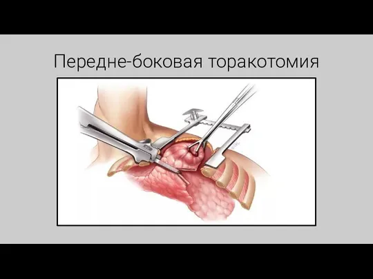 Передне-боковая торакотомия