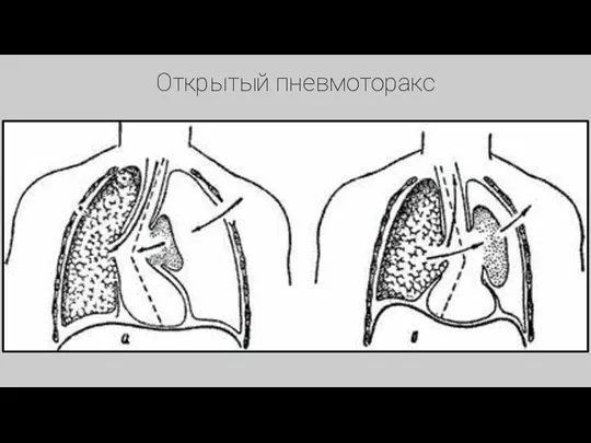 Открытый пневмоторакс