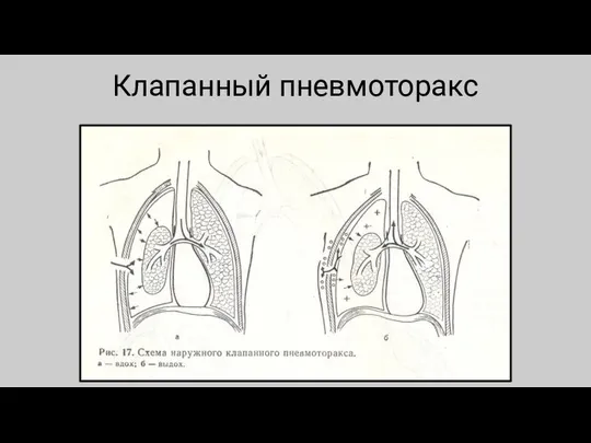 Клапанный пневмоторакс