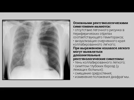 Основными рентгенологическими симптомами являются: • отсутствие легочного рисунка в периферических отделах соответствующего