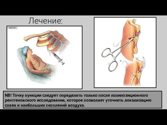 Лечение: NB! Точку пункции следует определять только после полипозиционного рентгеновского исследования, которое