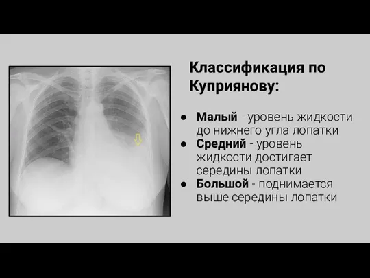 Малый - уровень жидкости до нижнего угла лопатки Средний - уровень жидкости