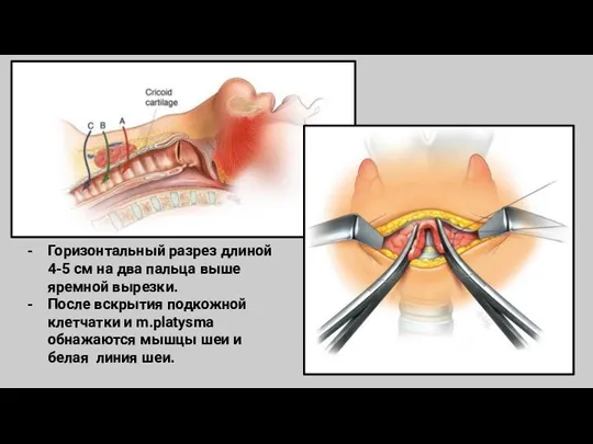 Горизонтальный разрез длиной 4-5 см на два пальца выше яремной вырезки. После