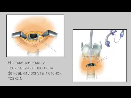 Наложение кожно-трахеальных швов для фиксации лоскута и стенок трахеи.