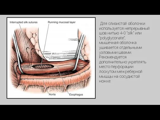Для слизистой оболочки используется непрерывный шов нитью 4-0 “silk” или “polyglyconate”, мышечная