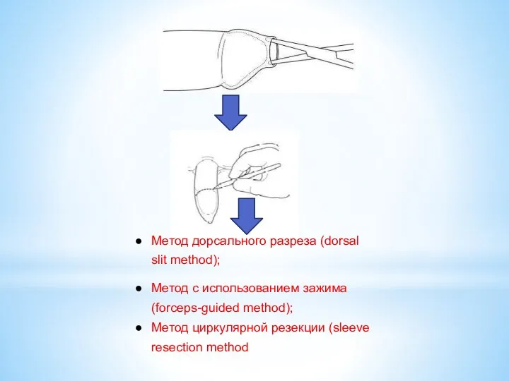 Метод дорсального разреза (dorsal slit method); Метод с использованием зажима (forceps-guided method);