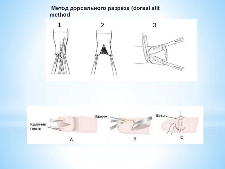 Метод дорсального разреза (dorsal slit method