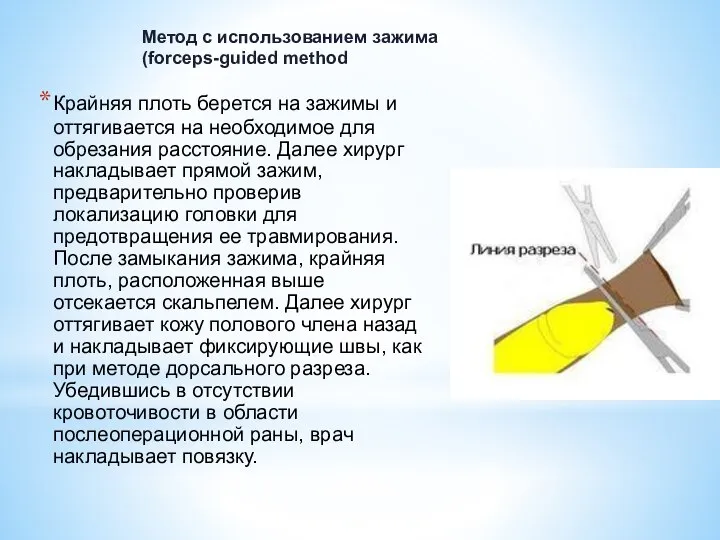 Крайняя плоть берется на зажимы и оттягивается на необходимое для обрезания расстояние.