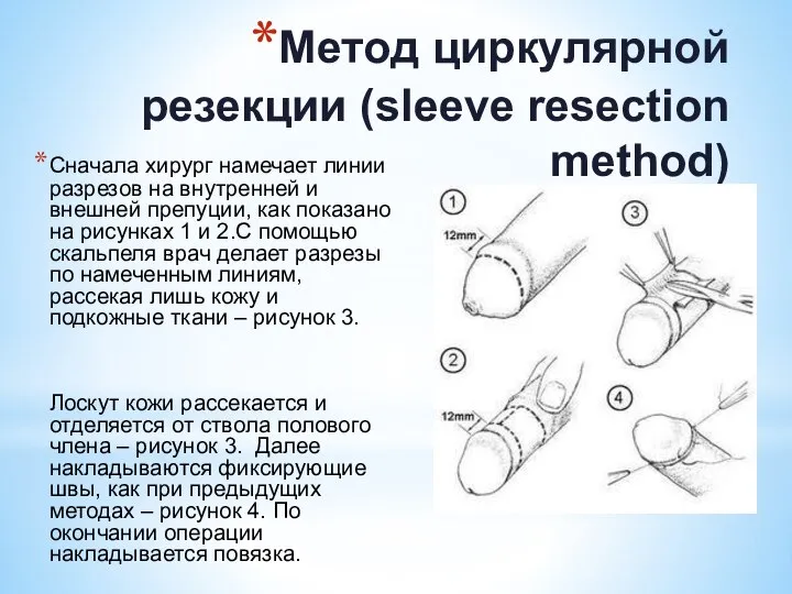 Метод циркулярной резекции (sleeve resection method) Сначала хирург намечает линии разрезов на