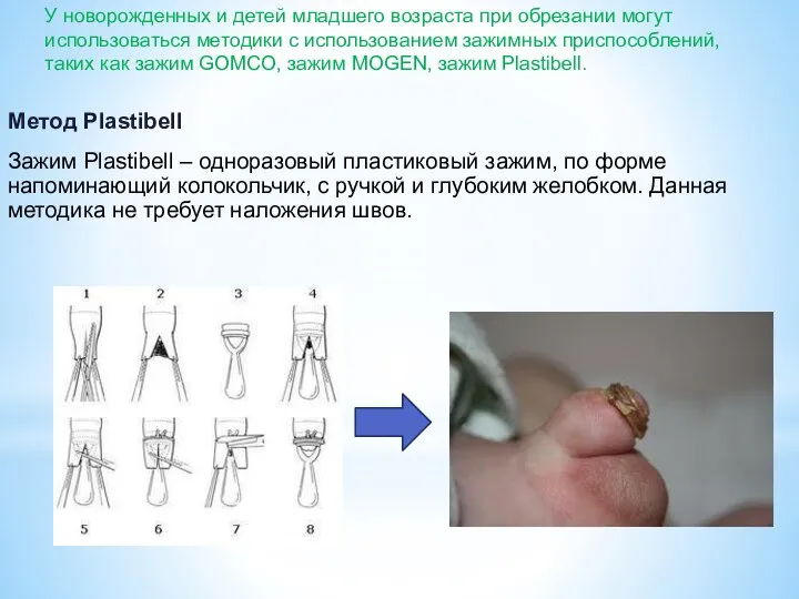 Метод Plastibell Зажим Plastibell – одноразовый пластиковый зажим, по форме напоминающий колокольчик,