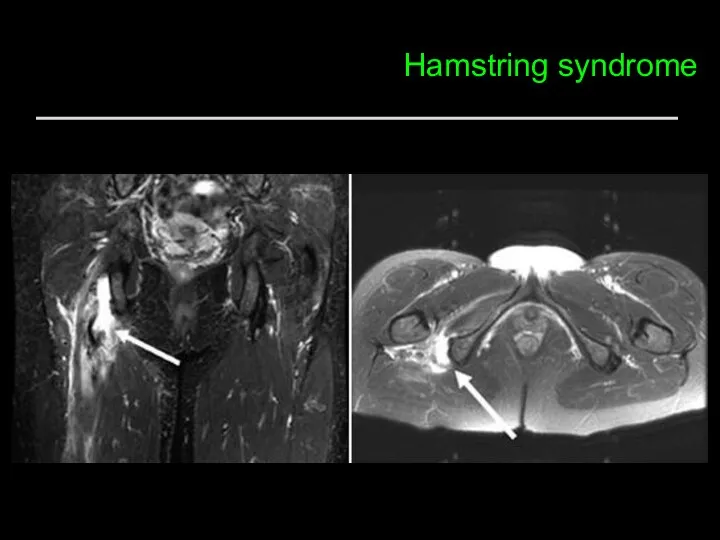 Hamstring syndrome