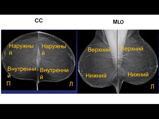 СС МLO П Л Л Наружный Наружный Внутренний Внутренний Верхний Верхний Нижний Нижний