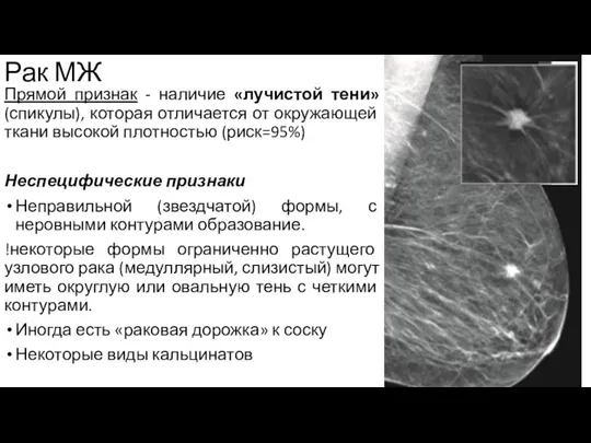 Рак МЖ Прямой признак - наличие «лучистой тени»(спикулы), которая отличается от окружающей