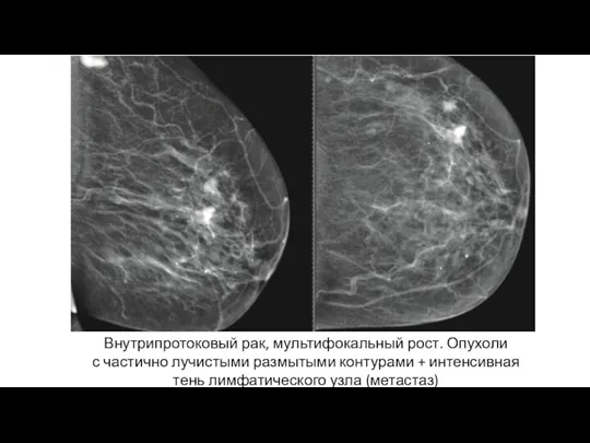 Внутрипротоковый рак, мультифокальный рост. Опухоли с частично лучистыми размытыми контурами + интенсивная тень лимфатического узла (метастаз)