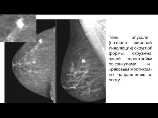 Тень опухоли (на фоне жировой инволюции) округлой формы, окружена зоной перестройки со